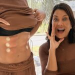 Harmonização abdominal amplia possibilidades para redefinir o contorno corporal sem cirurgia